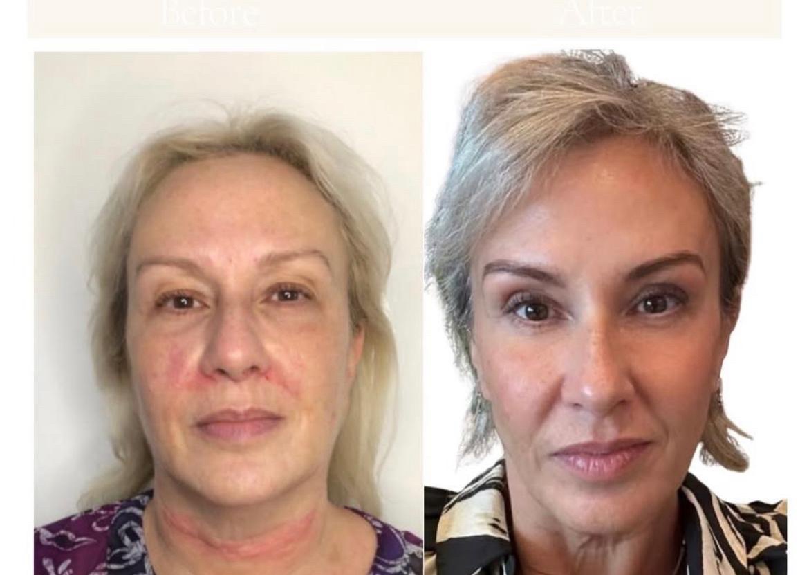 Before and after photograph: Eight week aesthetic journey - before and after, shared with written client consent